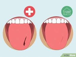 Bitten Tongue Emergency