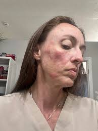 Hey folks...ive taken a horrendous itch all over to the point I could  cry.Can anybody recommend anything..im