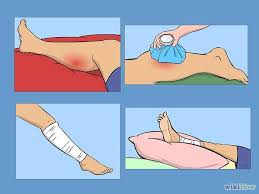 How To Treat A Torn Calf Muscle Torn Calf Muscle Torn Calf Muscle Treatment Pulled Calf Muscle Treatment