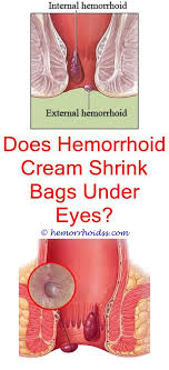 Pin On Hemorrhoid Surgery