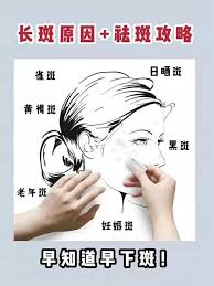 斑是怎么长的 晚睡 熬夜 开灯睡觉 内分泌失调 不做防晒 怀孕 激素不平衡 疲劳过度 思虑过重 生闷气