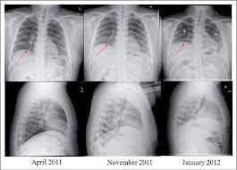Shrinking Lung Syndrome Presenting As An Initial Pulmonary Manifestation Of Sle Semantic Scholar