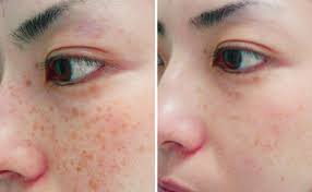 We at bright side have checked the professional tips and would like to share with you how you can reduce pigmentation naturally and get glowing skin. Best Laser Photorejuvenation Skin Pigmentation Treatments Orlando Fl