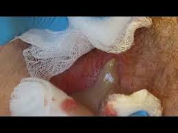 Zits Pimple Popping Zit Videos Pictures How To Pop Right Medical Photos Zits Popping Staph Infection