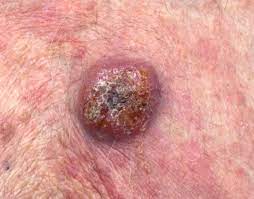 Lymphoma is a cancer that starts in cells that are part of the body's immune system. Lymphoma Action Skin Lymphoma