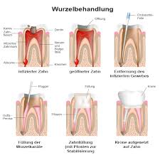 Wurzelbehandlung, essen danach und was du sonst zu beachten hast. Wurzelbehandlung Regiosmile Dr Peter Reill