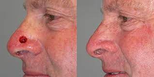 Thank you, {{form.email}}, for signing up. Secondary Intention Healing Skin Cancer And Reconstructive Surgery Center
