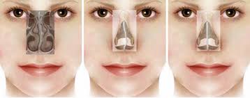 Image result for septoplasty