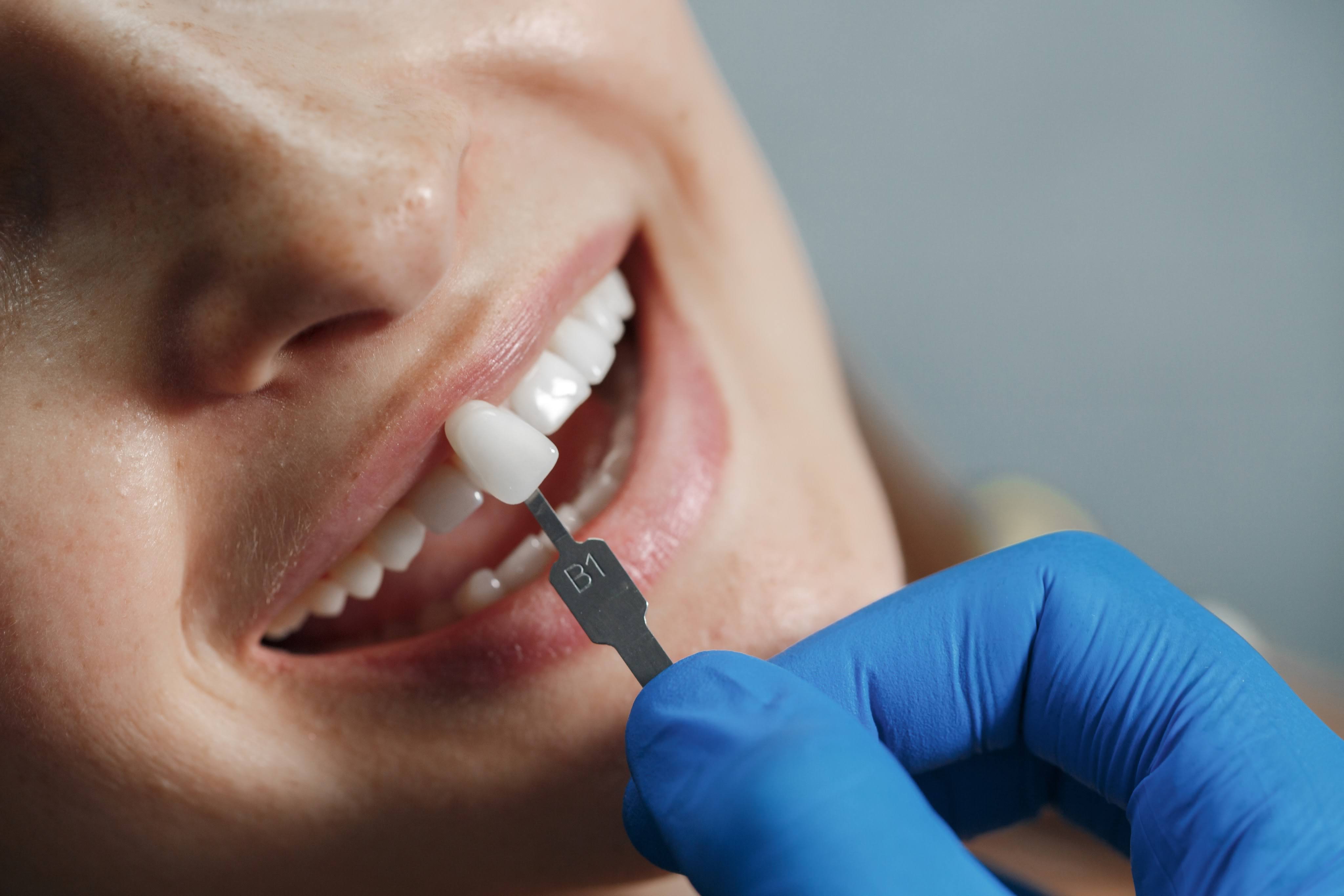 Dental Implants (Single Tooth to Full Mouth) product image