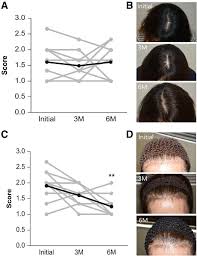 Image result for HAIR Score