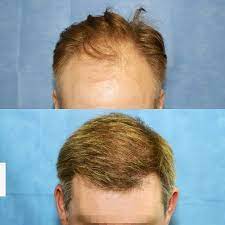 Receding Hair Line Fixed Before And After 2811 Grafts Were Transplanted During This Hair Res Hair Restoration Surgery Hair Restoration Receding Hair Styles