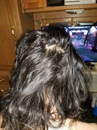 I have had dandruff for a long time but my hair fall started about four months back. My Boyfriend Has Dandruff A Lot Of It He Scrubs It All Out In The Shower And It S Back The Next Day His Roots Get Ashy And These Flakes Just Fall Off