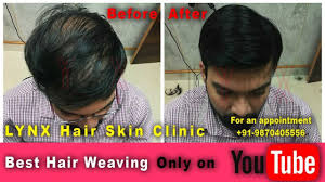 A new hair weave is a great way to mix up your style, and give your look a new bit of flair. Before After Hair Weaving Hair Fixing Hair Bonding In India Weave Hairstyles Hair Fixing Skin Clinic