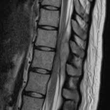 Image result for Spinal Epidural Abscess