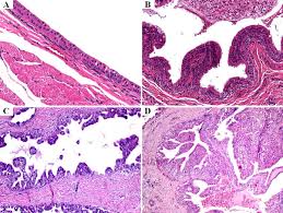 Although the dominant component of the tumor was composed of clear cells, mucin containing cells were also. P63 Expression In Papillary Cystadenoma And Mucoepidermoid Carcinoma Of Minor Salivary Glands Oral Surgery Oral Medicine Oral Pathology And Oral Radiology