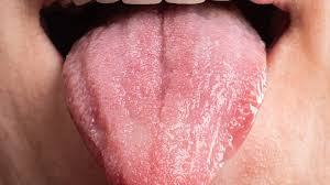 Image result for brown tongue symptoms