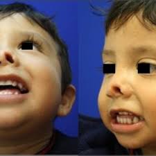 PDF) Pediatric nasal reconstruction with frontal flap: a case report