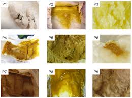 Image result for yellow stool human poop