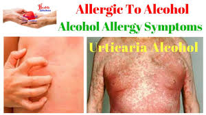 Can you really be allergic to alcohol? Alcohol Allergy Allergic To Alcohol Alcohol Allergy Symptoms