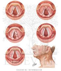 It sits above the windpipe (trachea) in the neck and in front of the food pipe. Cancer Of The Larynx