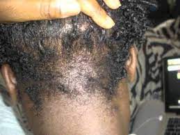 I have to wear a hat all the time when i cooked in a commercial setting. Natural Hair 2011 Nape Breakage And My Story Youtube