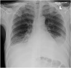 Learn about different types of pleural effusions, including symptoms, causes, and the pleura is a thin membrane that lines the surface of your lungs and the inside of your chest wall. Dasatinib As A Probable Cause Of Bilateral Chylothorax In A Patient With Chronic Myeloid Leukemia Case Report Springerlink