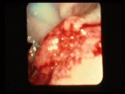 Kidney removed, ten yrs on, still cancer free. Gastric Cancer Cancer Therapy Advisor