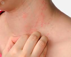 Meccanismi Che Scatenano La Psoriasi Dott Enzo Berardesca