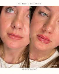 Beautiful lips from every angle 😍 This beauty had a wonderful shape to  start with, we just enhanced it with filler. She is stunning!  #aesthetictreatments #injectables #nursepractitionerinjectors  #beautyenhancer #medicalspa #cosmeticinjectables ...