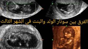 أما الجنين في المرحلة الثالثة يكون قد اكتمل واستوى وخاصة بعد الشهر بعد الزواج والمعاشرة الزوجية الطويلة، يبدا الزوجان في انتظار مولودهم الاول، وتبدا المرأة بملاحظة اي تغير يطرا عليها وقد يكون يدل. Ù…Ø¹Ø±ÙÙ‡ Ù†ÙˆØ¹ Ø§Ù„Ø¬Ù†ÙŠÙ† Ù…Ù† Ø´ÙƒÙ„ ÙƒÙŠØ³ Ø§Ù„Ø­Ù…Ù„ ÙÙŠ Ø§Ù„Ø³ÙˆÙ†Ø§Ø± Youtube
