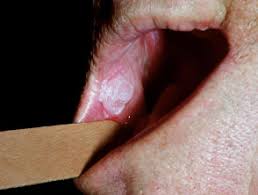 Besides that, the following are among the symptoms that might indicate the presence of oral cancer. Carcinoma In Situ Of Oral Cavity Dermnet Nz