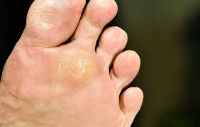 View 8 546 nsfw pictures and enjoy feet with the endless random gallery on scrolller.com. 5 Nasty Skin Conditions You Can Pick Up At The Gym Men S Health