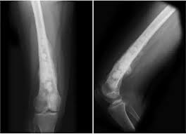 Image result for Osteosarcoma