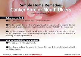 Canker Sore Hkme Remedy Canker Sore Mouth Ulcers Cold Sores Remedies