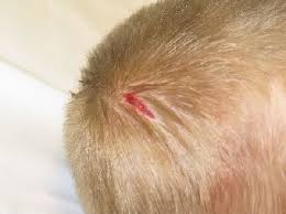 Image result for sores on the head in children