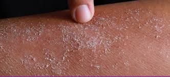 Image result for dermatitis contacta