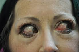 Image result for Proptosis