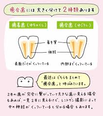 癒合 歯 癒着 歯