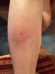 Schwellung und überwärmung des betroffenen arms. Compgefa Thrombophlebitis