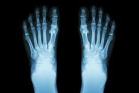 Image result for Metatarsal