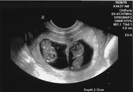 كيف ينمو التوأم داخل رحم الأم تسعة أشهر