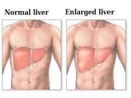 Hepatocellular carcinoma is the most common type feeling full after a meal, especially a slight meal, is a common sign of a problem with the liver or stomach. Warning Signs And Symptoms Of Liver Cancer Most People Ignore
