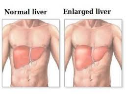 Liver cancer symptoms signs and symptoms of liver cancer may depend on the size of the tumor and if it has spread outside the liver. Warning Signs And Symptoms Of Liver Cancer Most People Ignore