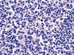 Merkel cell carcinoma most often develops in older people. Pathology Outlines Metastases