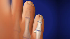 Minimal Incision Toe Bone Spur Removal Southern California Orthopedic Institute