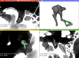 Image result for Ossicular Chain Disruption