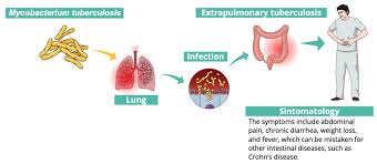 Image result for Extrapulmonary Tuberculosis