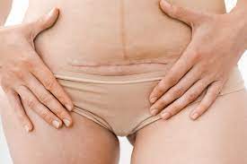 Bottom line, i want women to feel empowered. 20 Things You Should Avoid After A Cesarean Being The Parent