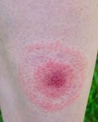 11 Common Bug Bite Pictures How To Id Insect Bites And Stings