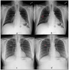 For tumblr, facebook, chromebook or websites. Deep Learning In Chest Radiography Detection Of Findings And Presence Of Change